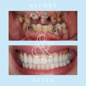 Can you get implants if you have bad teeth?