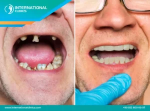 How to fix missing teeth without implants?