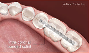 Is tooth splinting painful?