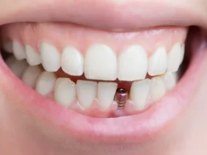 Is a single tooth implant worth it?