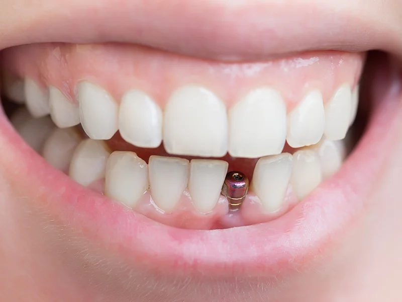 Is a single tooth implant worth it?