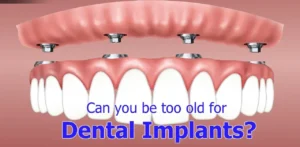 Is 60 too old for dental implants?