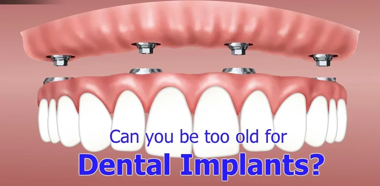 Is 60 too old for dental implants?