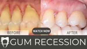 How much does a gum graft cost for receding gums?