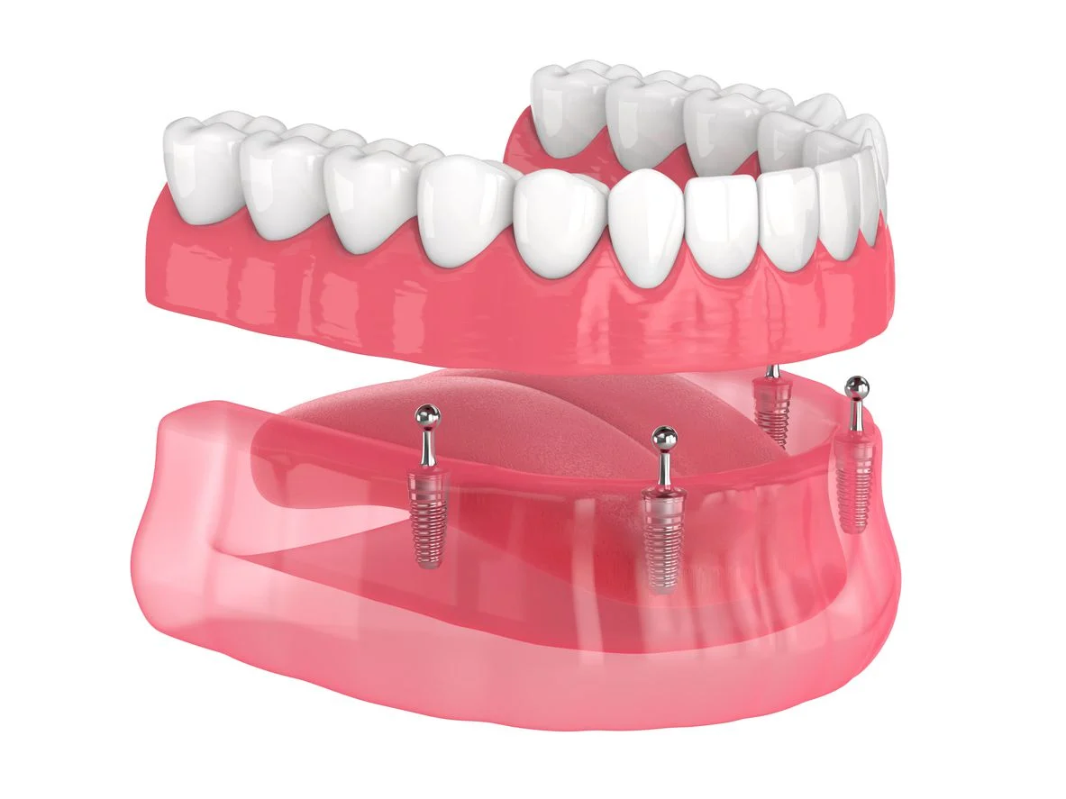 What is a mini dental implant?