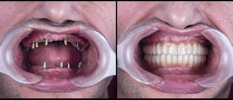 Can I get dental implants if I have no teeth?