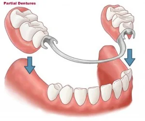 What is the cheapest way to replace a missing tooth UK?