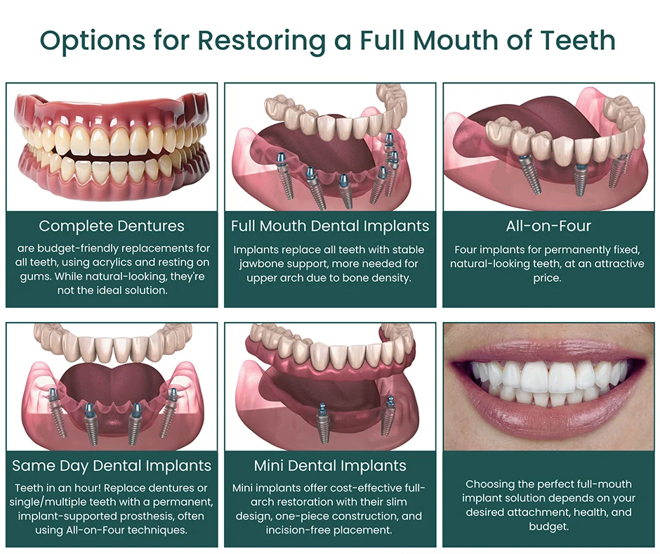 How many dental implants do you need for whole mouth?