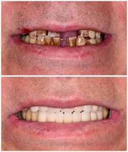 What can you do if you have bad teeth and no money in the UK?