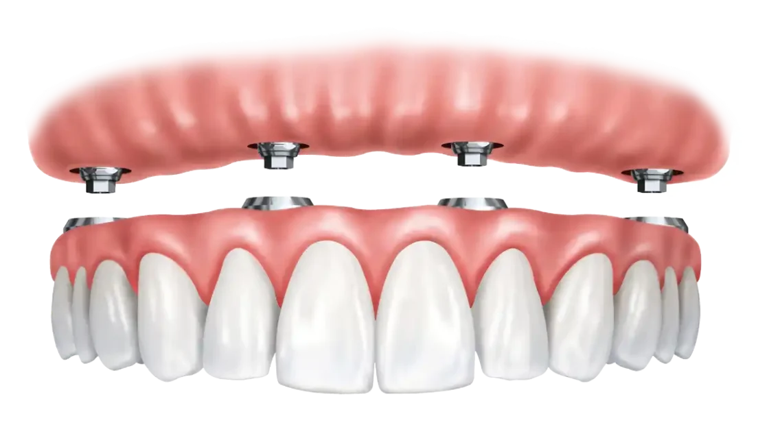 full set denture implants