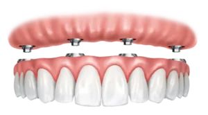 full set dental implants