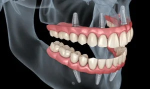 How long does it take to recover from full mouth dental implant surgery?