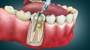 Will my tooth be OK without a crown?