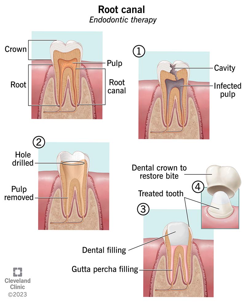 How painful are root canals?