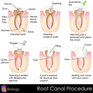 Is an extraction better than a root canal?