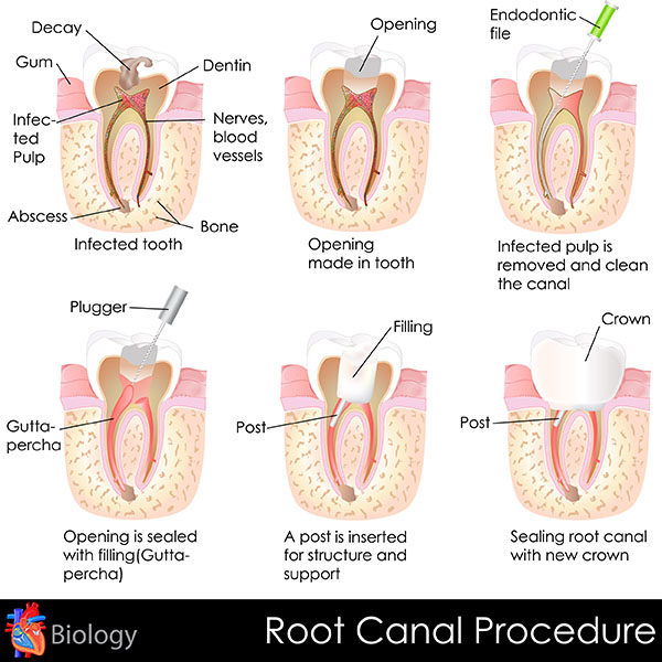 Is an extraction better than a root canal?