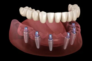 full jaw implants