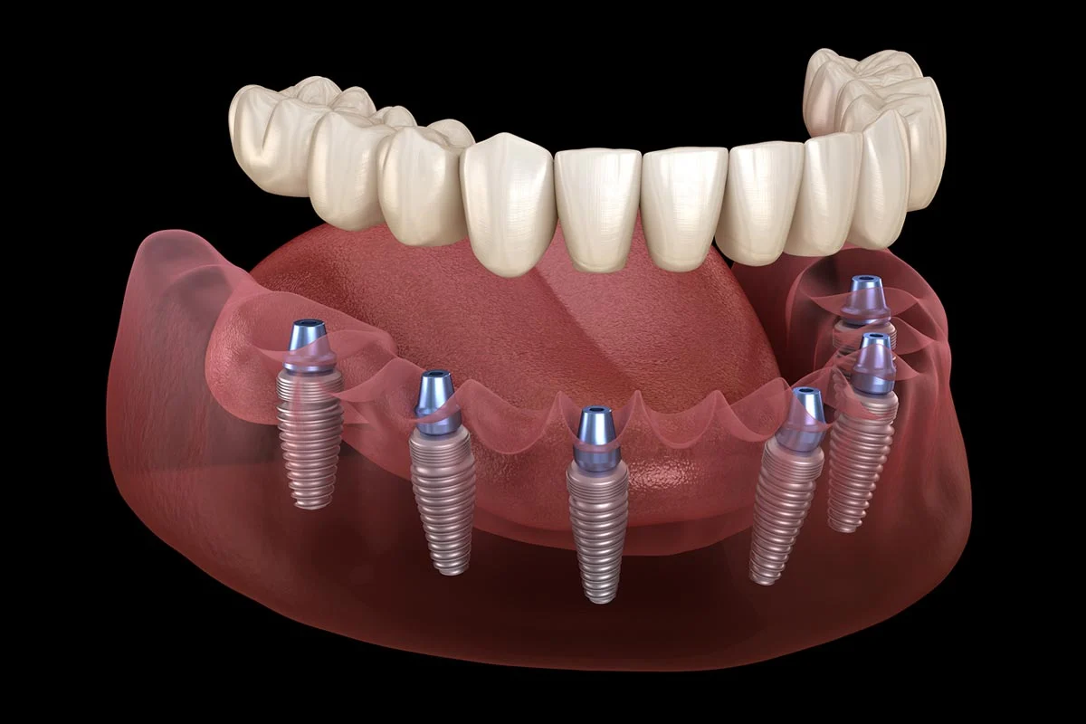 full jaw implants