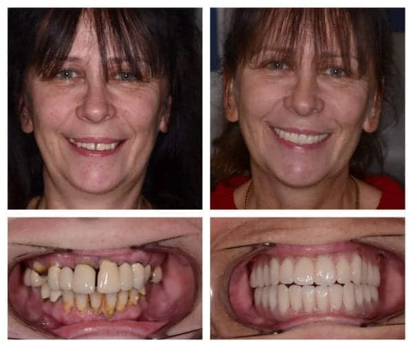 Why not replace teeth with implants?
