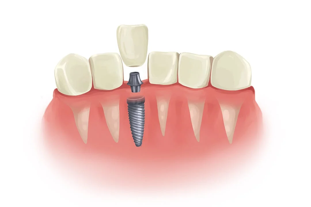 When are dental implants not suitable?