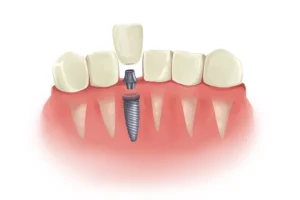 When not to have a dental implant?