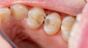 How do you tell if a tooth is dying under a crown?