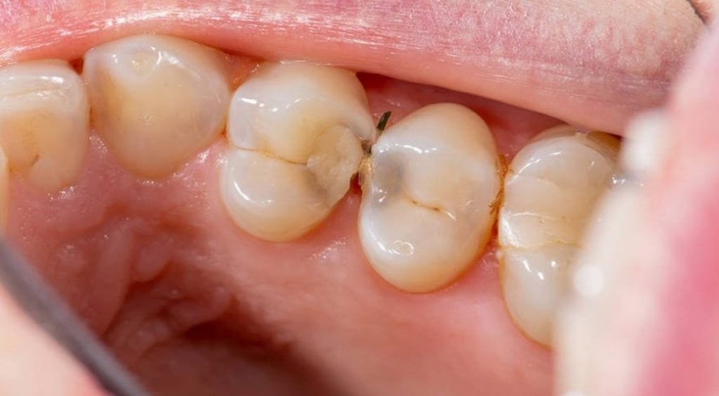 How do you tell if a tooth is dying under a crown?
