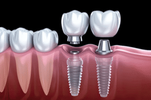 tooth transplant