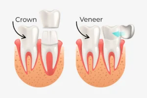 Is a tooth crown painful?