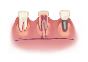 What hurts more, tooth extraction or implant?